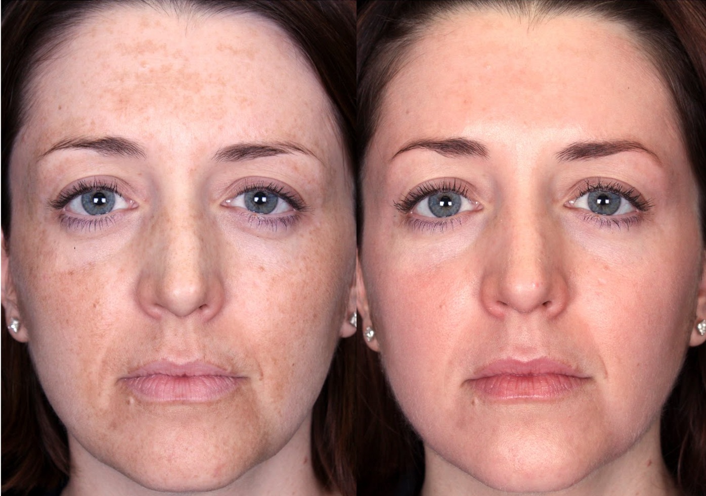 Brown facial spot treatment