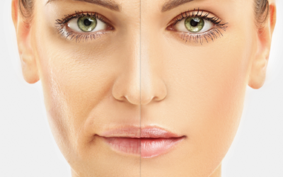 The Benefits of a Cosmetic Pharmaceutical Grade Chemical Peel