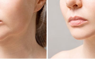 Are Fillers right for my “Jowls”?